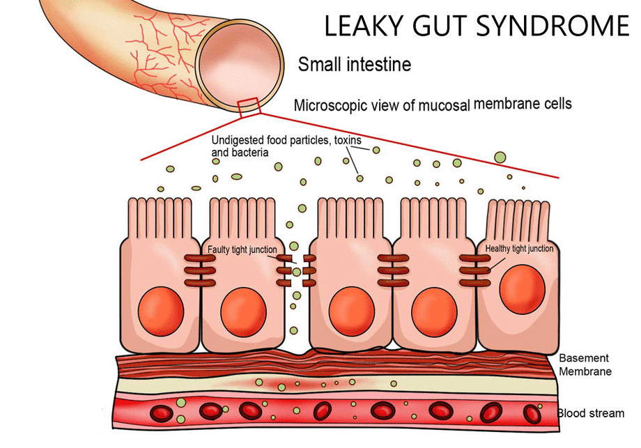 Leaky Gut Demystified - True Carnivores